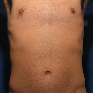 Result after 4 laser hair removal treatments