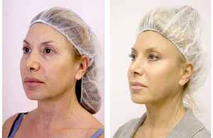 before-and-after-silhouette-soft-treatment-female-patient