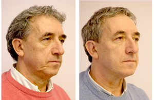 before-and-after-silhouette-soft-treatment-male-patient-2