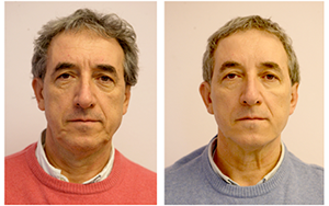 before-and-after-silhouette-soft-treatment-male-patient