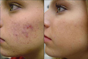 acne-treatment-at-the-fab-clinic