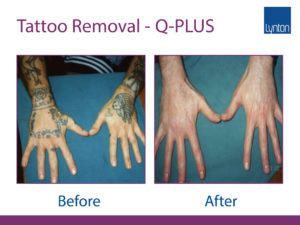 tattoo removal