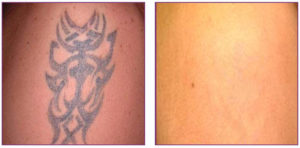 tattoo removal