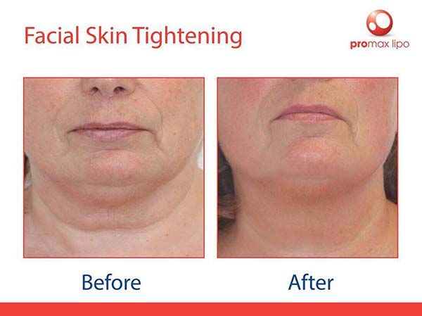 ProMax Lipo - before and after images of facial skin tightening