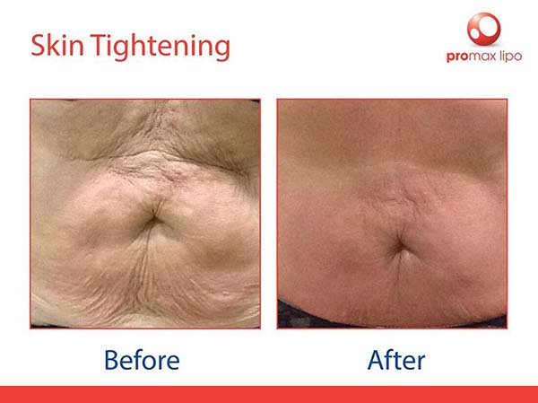 ProMax Lipo - before and after images of body skin tightening