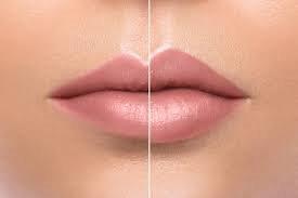 Lip Filler Used Correctly