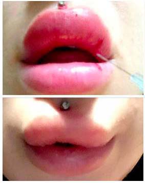 Lip Filler Frenzy!