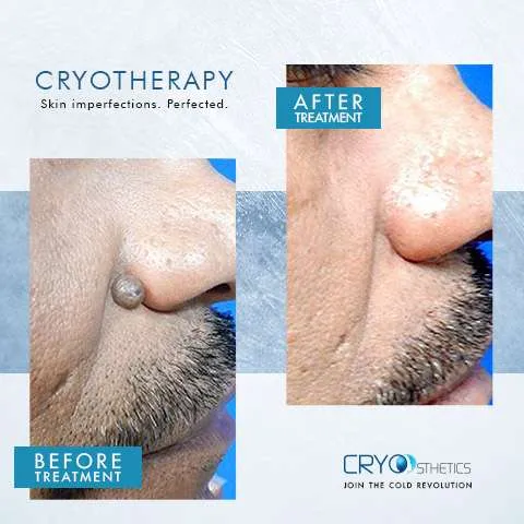 Cryotherapy Before & After