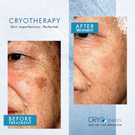 Cryotherapy Before & After