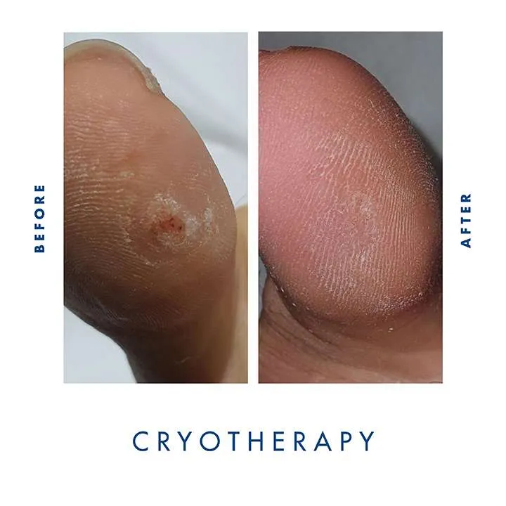 Cryotherapy Before & After