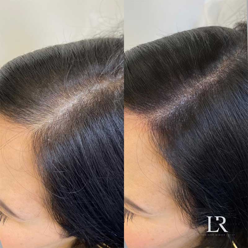 Scalp Micropigmentation Before & After