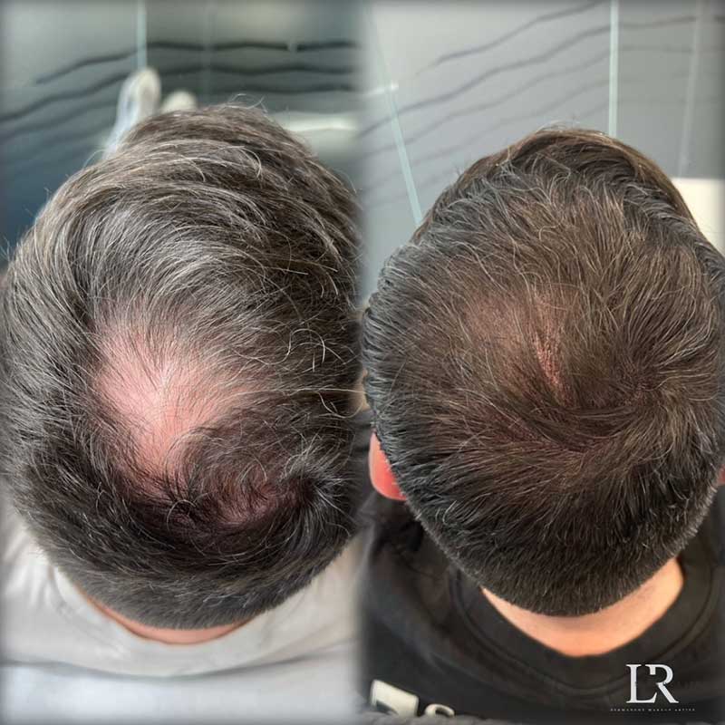 Scalp Micropigmentation Before & After