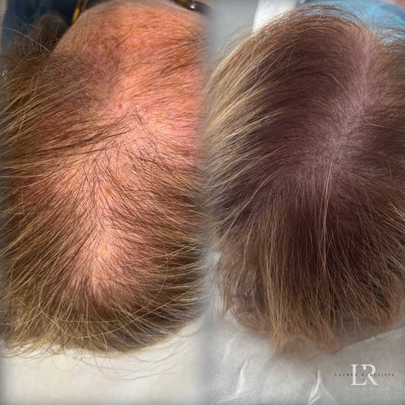 Scalp Micropigmentation Before & After