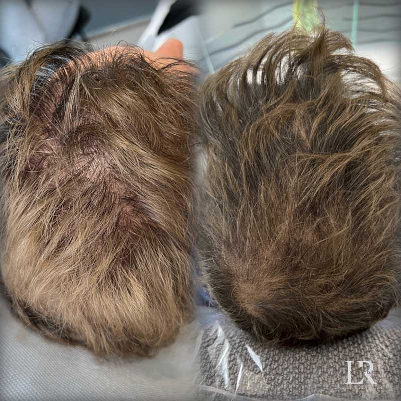 Scalp Micropigmentation Before & After